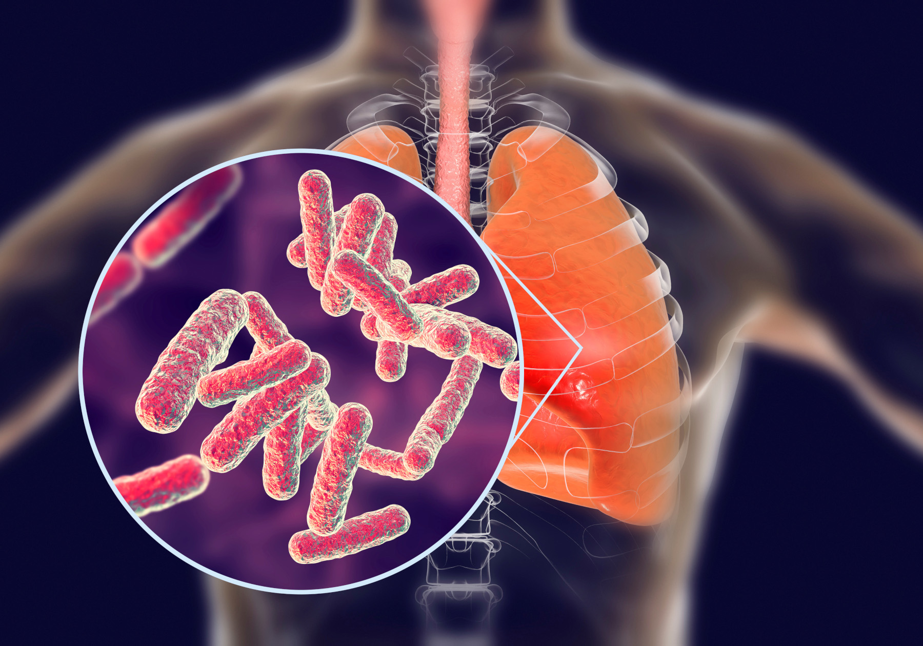 New TB Treatment For Developing Countries To Cost $1,040