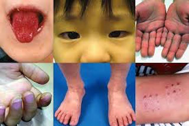 102 Kids In New York Down With Kawasaki Disease