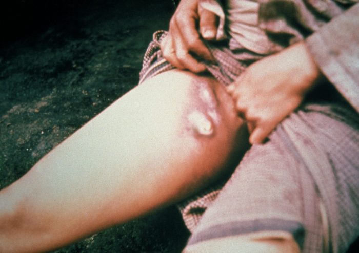 Bubonic Plague Reported In America
