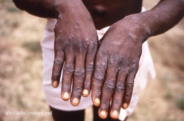 Monkeypox Enugu Govt Lauches Health Surveillance